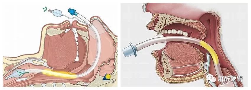 鼻肠管置入位置图片图片
