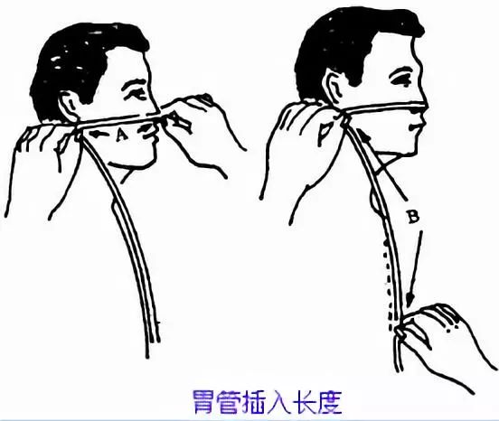 插胃管可能出现情况及解决方法(附操作视频)值得收藏