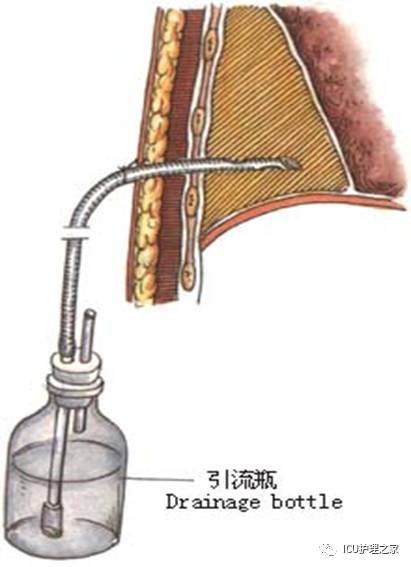 胸腔闭式引流管如何护理这些事别忽略