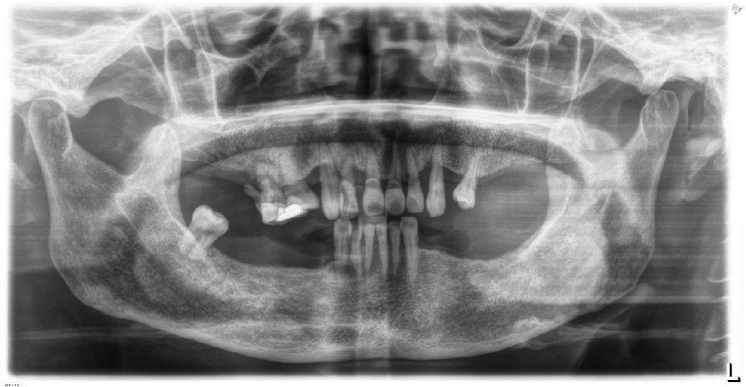 赵医生看了刘阿姨的牙齿全景x光片后,发现她有5颗松动牙,上牙3颗,下牙