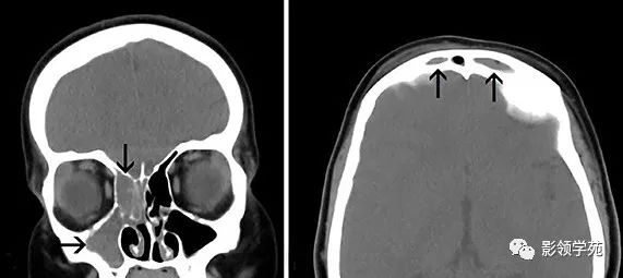 成像结果颅脑ct显示右上颌骨,右筛窦和双侧额窦密度增高(图1),右侧额