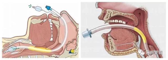 鼻咽通气管放置图片