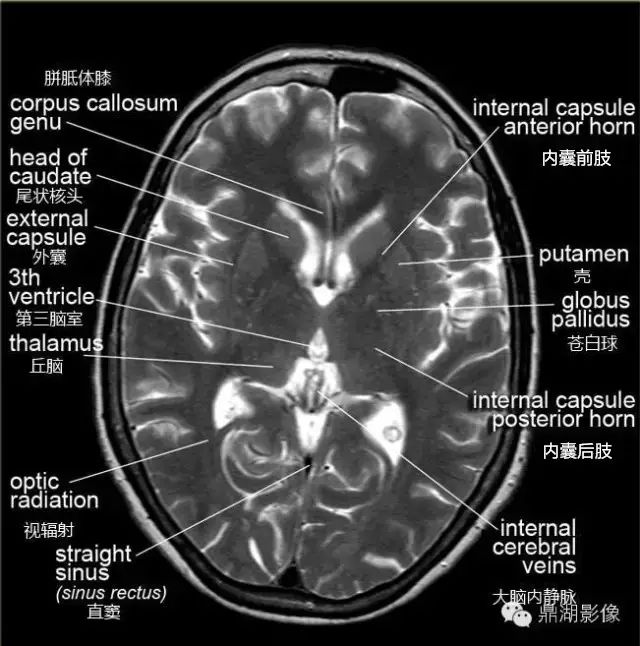 丘脑mri断层解剖图图片