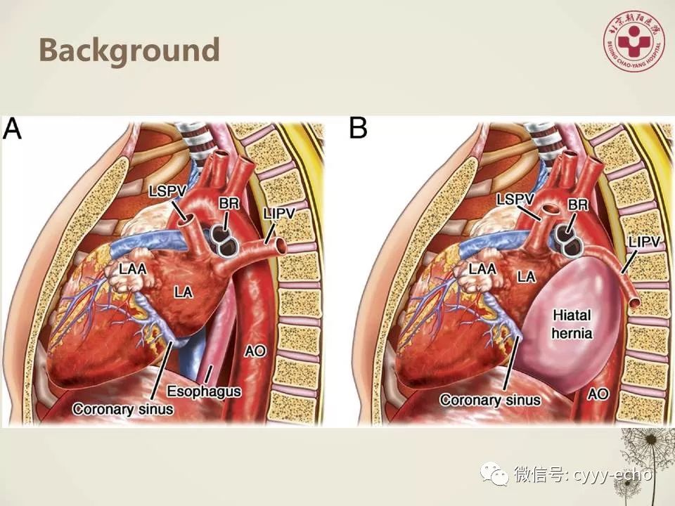 大食管裂孔疝患者進食導致左房受壓並影響心臟充盈的臨床研究