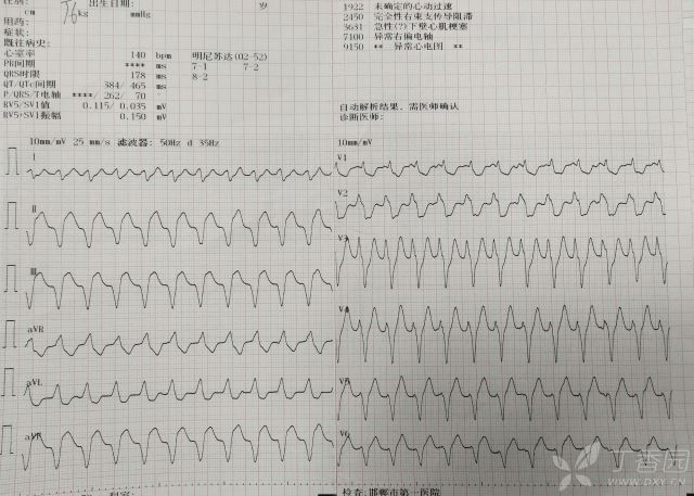 之後仍有間斷髮作室速數次,從需藥物,電覆律,逐步變為可自行復律.