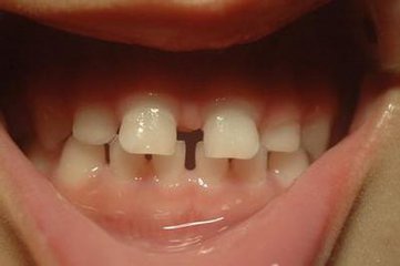 洛阳维乐口腔:5个方法解决牙齿缝隙大