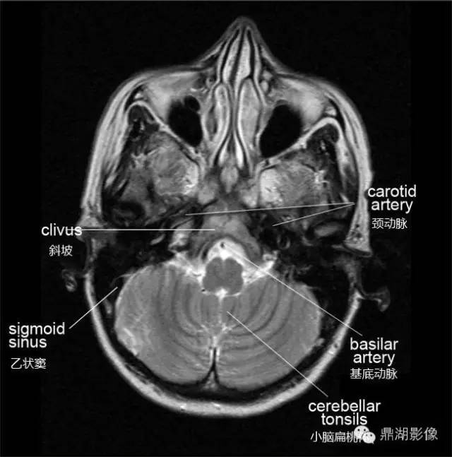 头颅磁共振定位图图片
