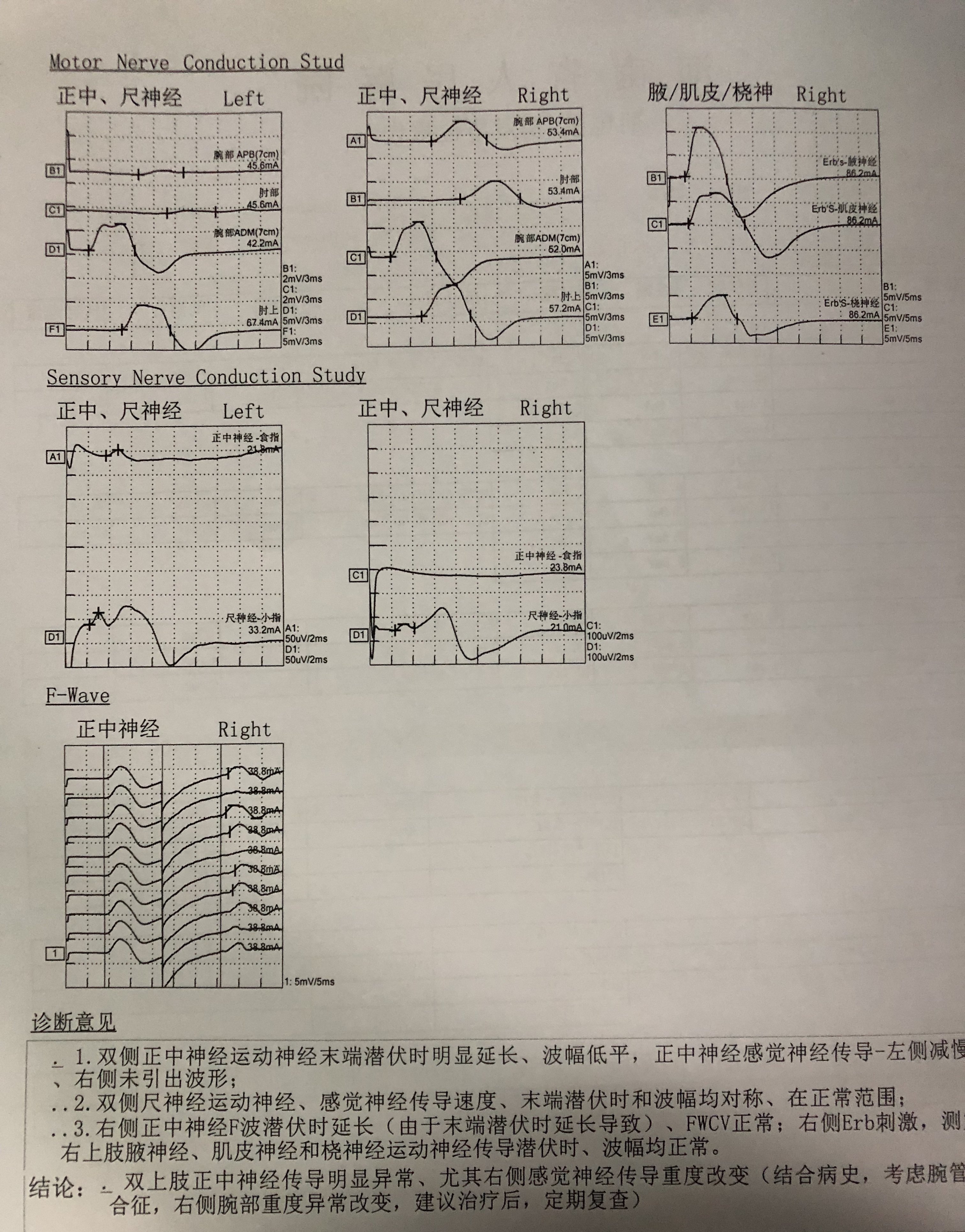 腕管綜合徵的診斷價值和肌電圖檢查結果的意義原創