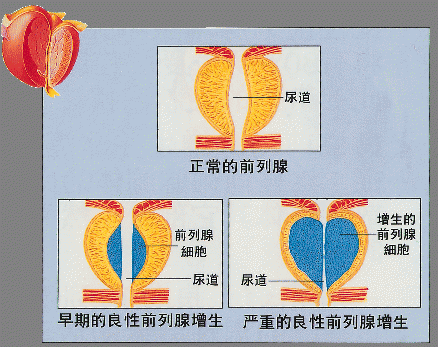 男人排尿不順暢原來是前列腺肥大瞭如何治療和保養