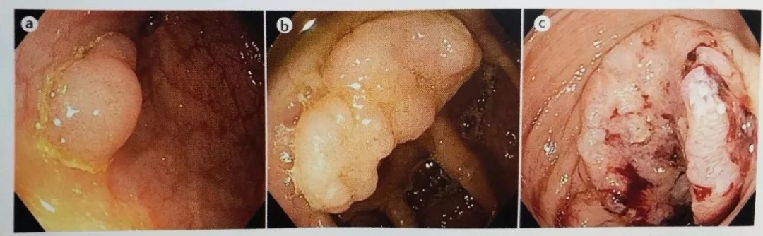 大肠癌侵犯图片