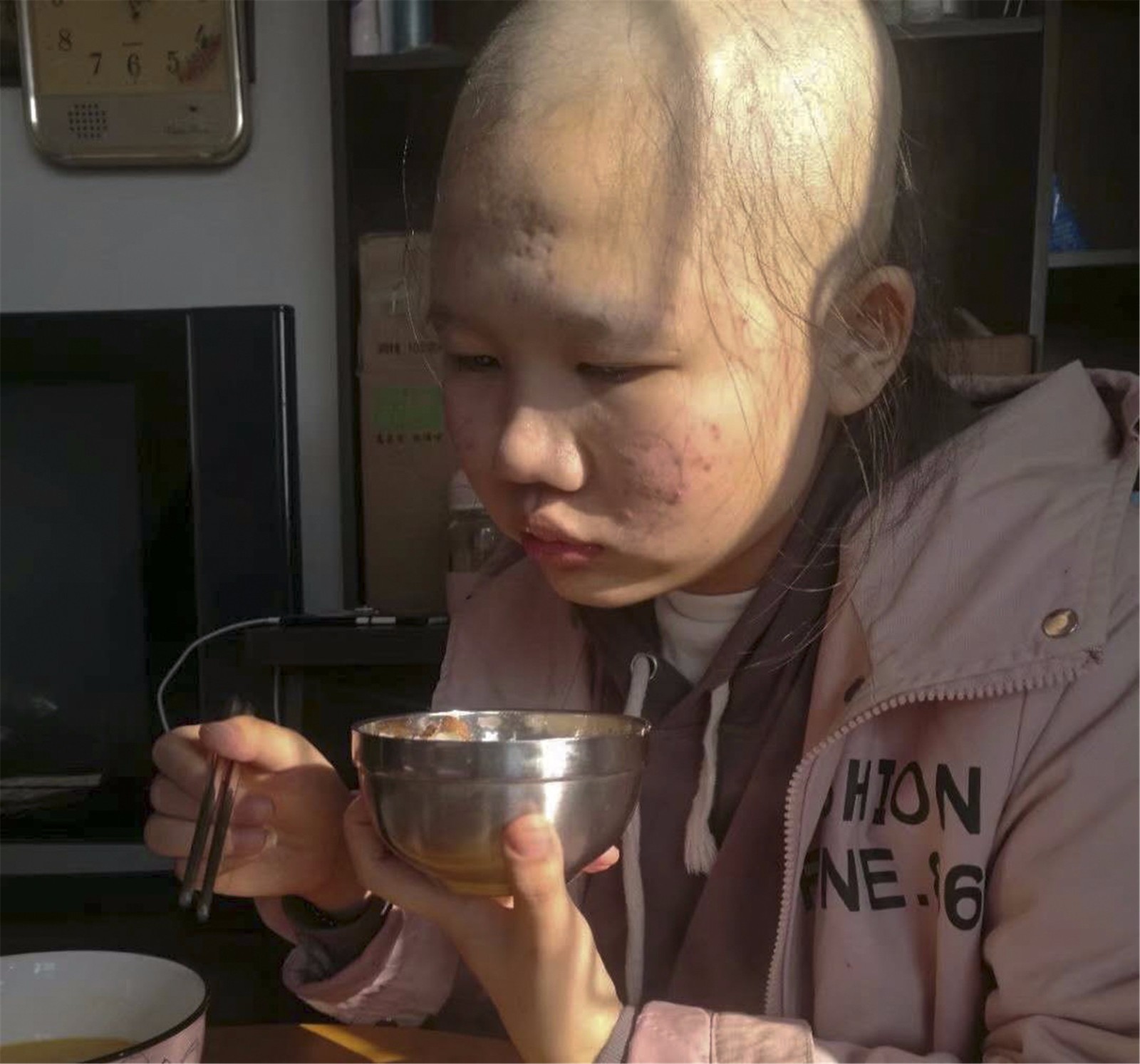 18岁女孩患肿瘤化疗掉光头发 生日愿望是买一顶假发