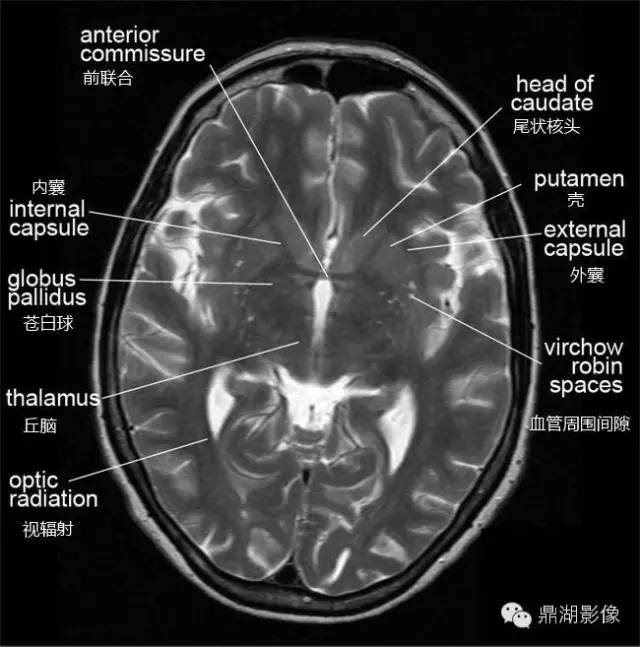 中脑mri解剖图图片