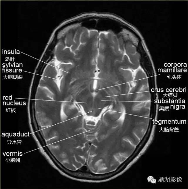 核磁头颅解剖图图片