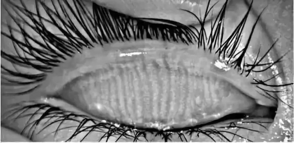 正常人的眼睑上大约有32个睑板腺,平行竖线状排列,分泌油脂用来湿润