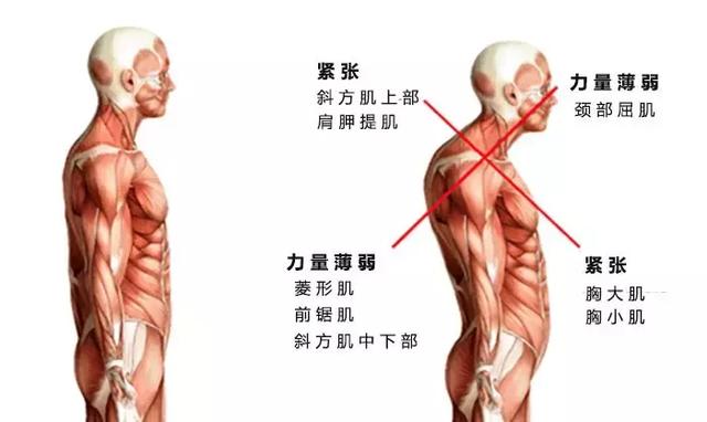 力量弱和过于紧张的肌群连成线,从人体侧面看很像一个x,所以这种