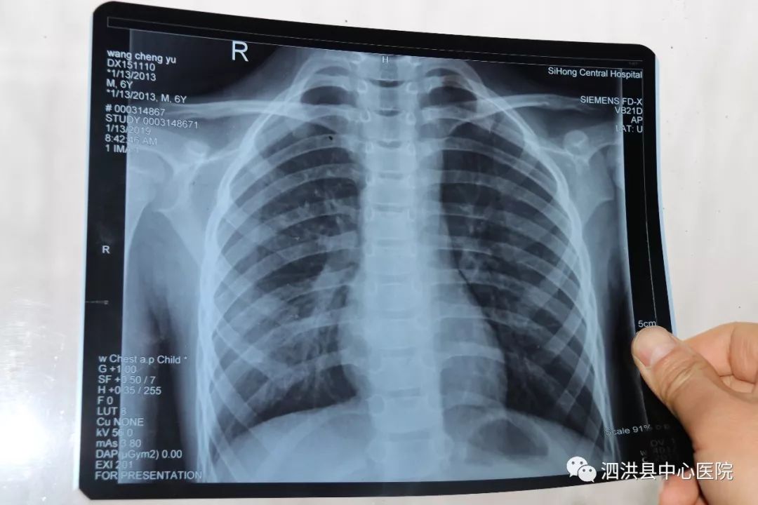 儿童胸片双肺纹理增粗图片