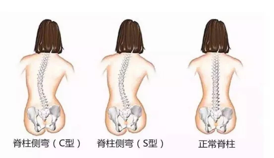 驼背与正常人侧面比照图片