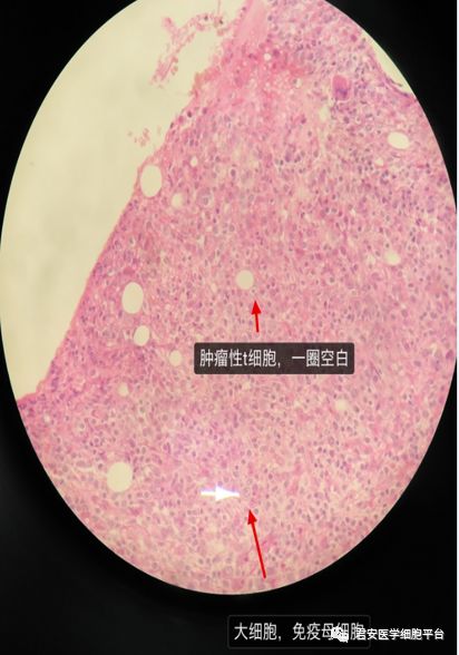 一例血管免疫母细胞性t细胞淋巴瘤病例分享
