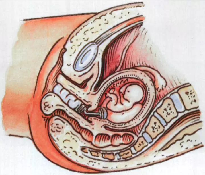 宫颈水囊图片