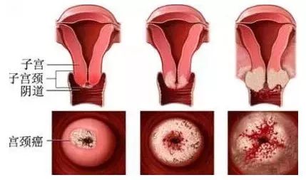 阴道镜检查也可用于外阴皮肤的相应病变观察,以及宫颈,阴道,外阴病变