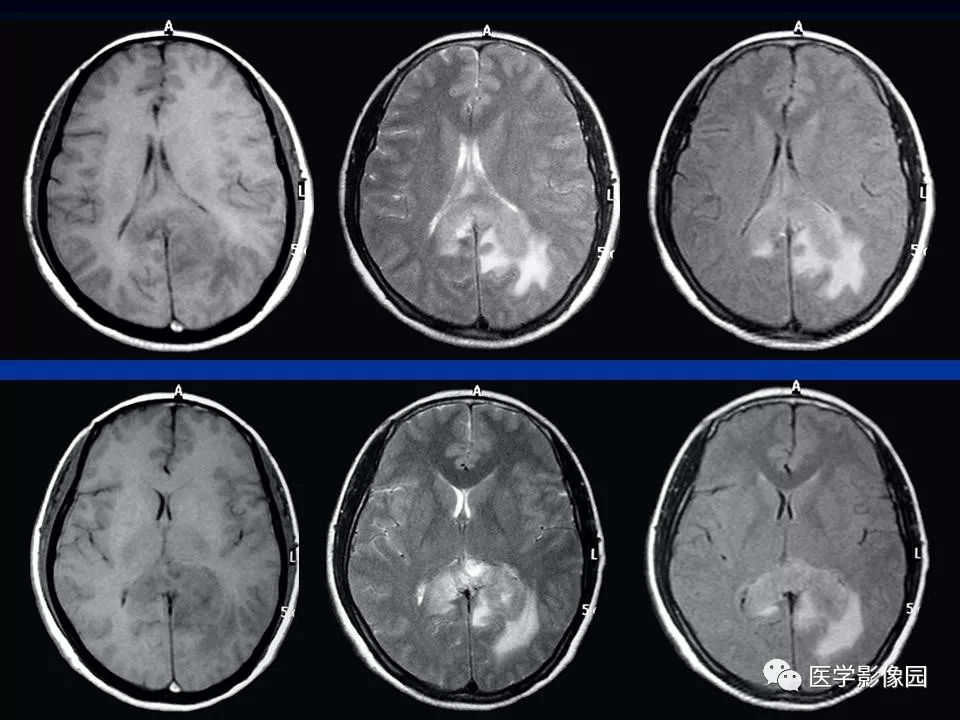 腦部原發性淋巴瘤的mri診斷 | 影像天地