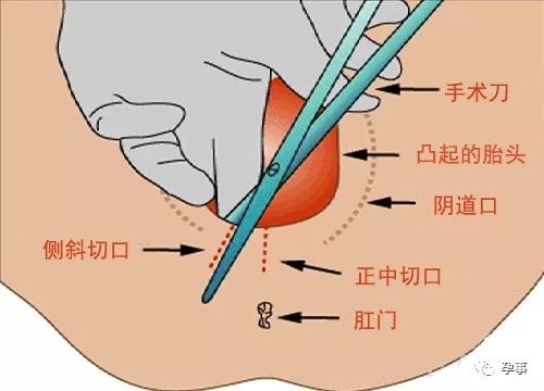 侧切 真实图片