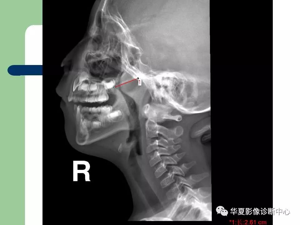 腺样体增大的x线测量与诊断