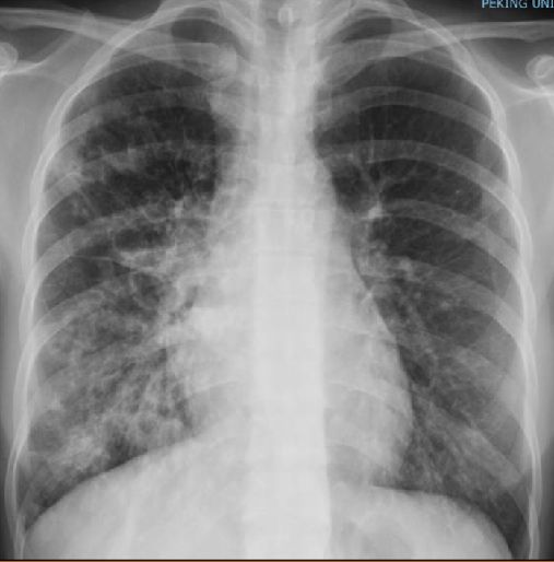 肺部感染的胸片图图片