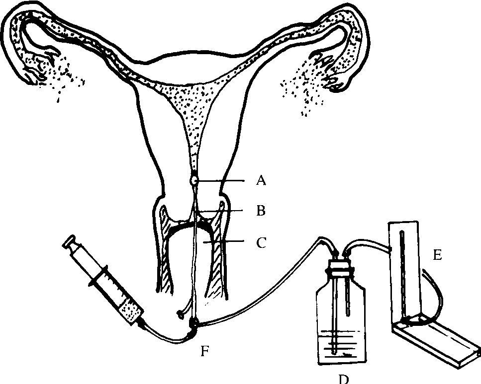 输卵管通水过程图片图片