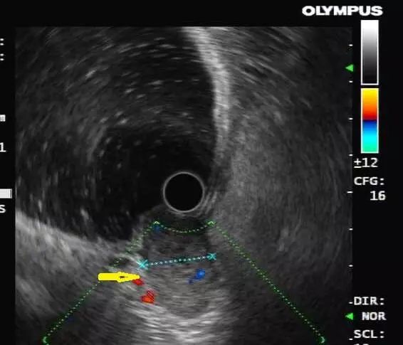技术贴丨胃间质瘤必须开刀?no,胃镜下即可挖除