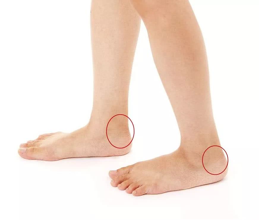 鼻子出血时,马上用拇指和食指捏脚后跟(踝关节及足跟骨之间的凹陷处)