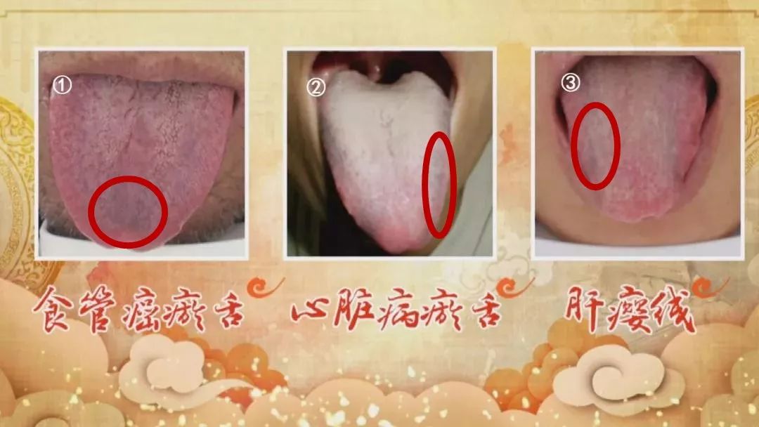 舌头癌症自测图片图片
