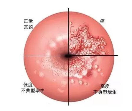 宫颈癌为妇科恶性肿瘤之一,发病率仅次于乳腺癌,位居全球第2位