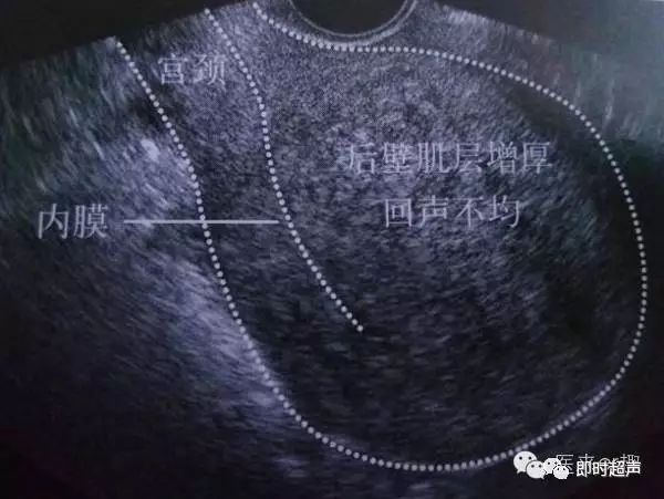 在蒂部可见点状或短条状血流信号,考虑子宫内膜息肉或是黏膜下子宫