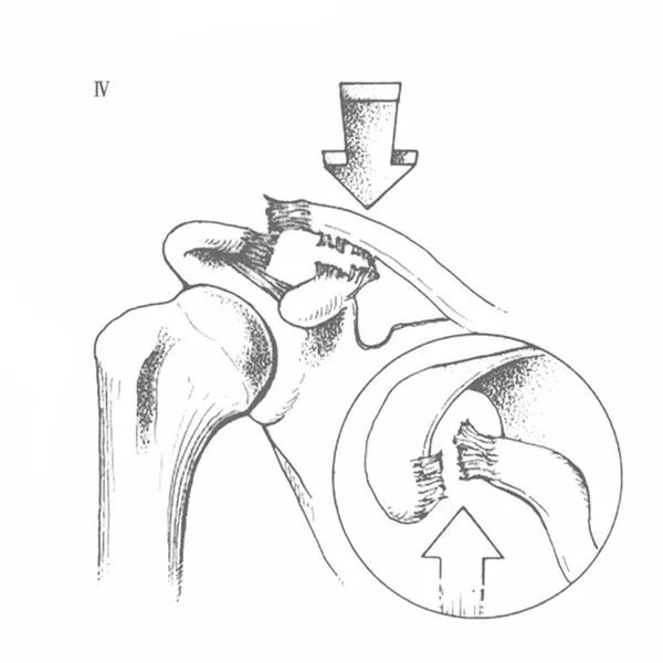 肩锁韧带损伤图片