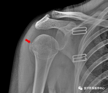 肩关节右侧尺骨中段可见斜形骨折线,骨折端稍分离移位