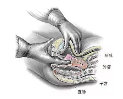 畸形或肿块;●有无宫颈接触性出血;●若上抬宫颈时感到疼痛称宫颈举痛