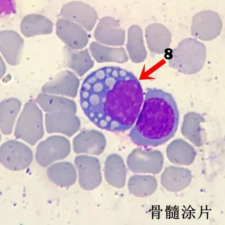 图4:淋巴瘤细胞(burkitt淋巴瘤患者)图3:血小板卫星现象(edta盐所致