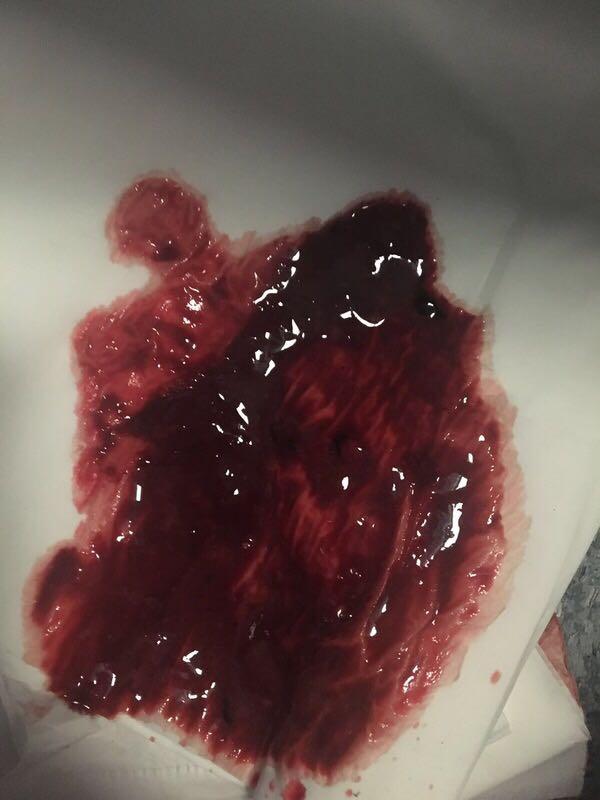 小肠出血的粪便图片图片