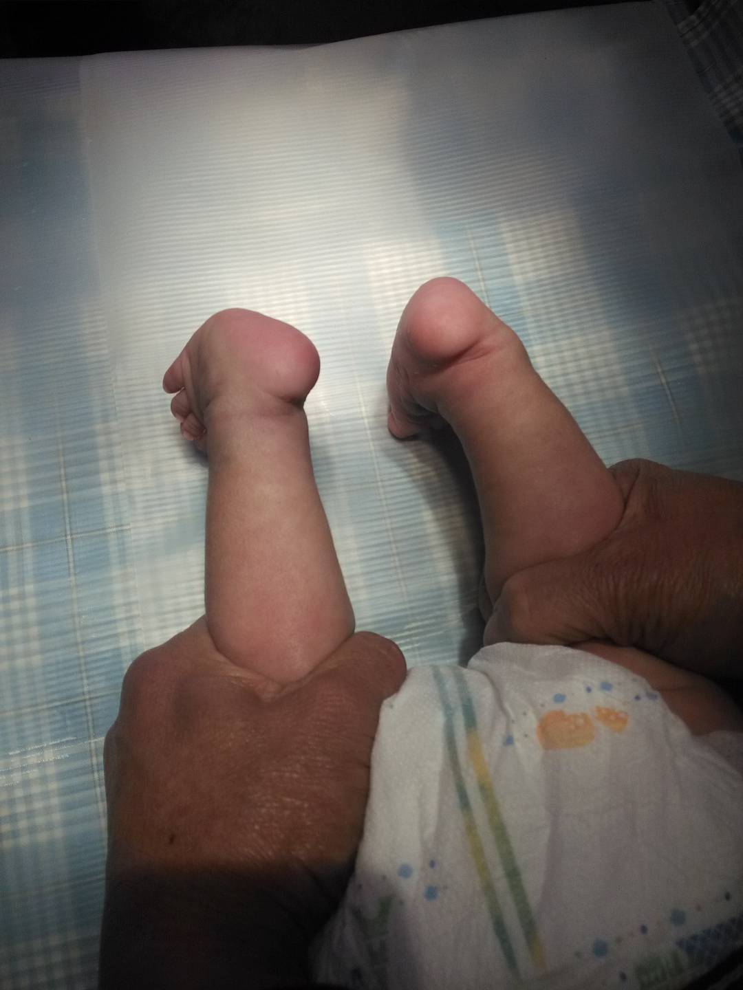 四个月宝宝脚内翻图图片