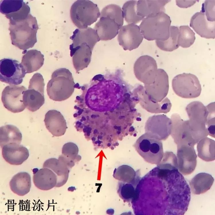 图4:淋巴瘤细胞(burkitt淋巴瘤患者)图3:血小板卫星现象(edta盐所致