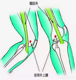 跑步膝盖痛髂胫束综合征怎么办