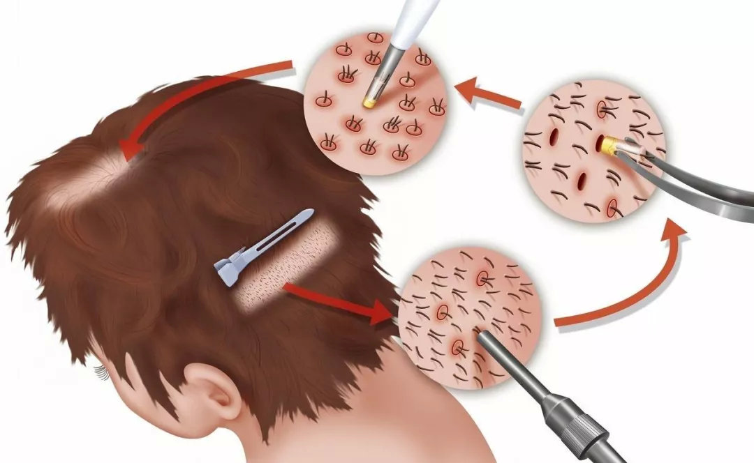头发种植手术