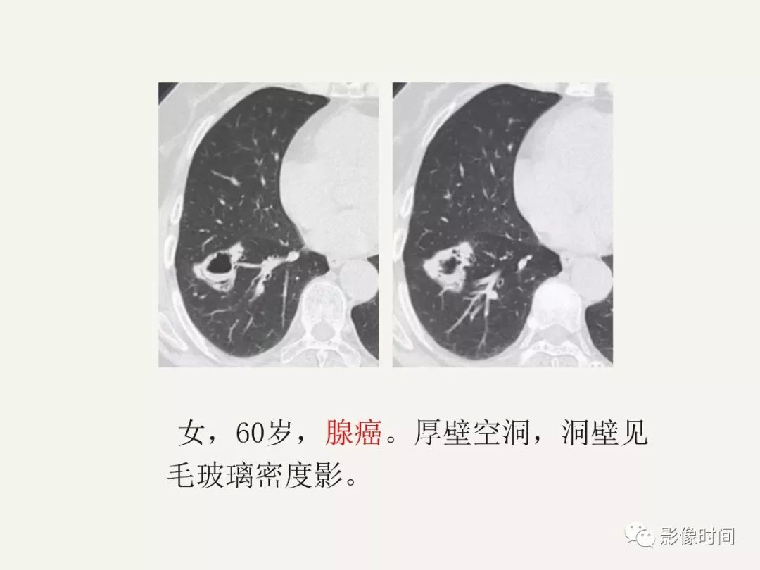 空洞型肺癌的 ct 診斷要點分析