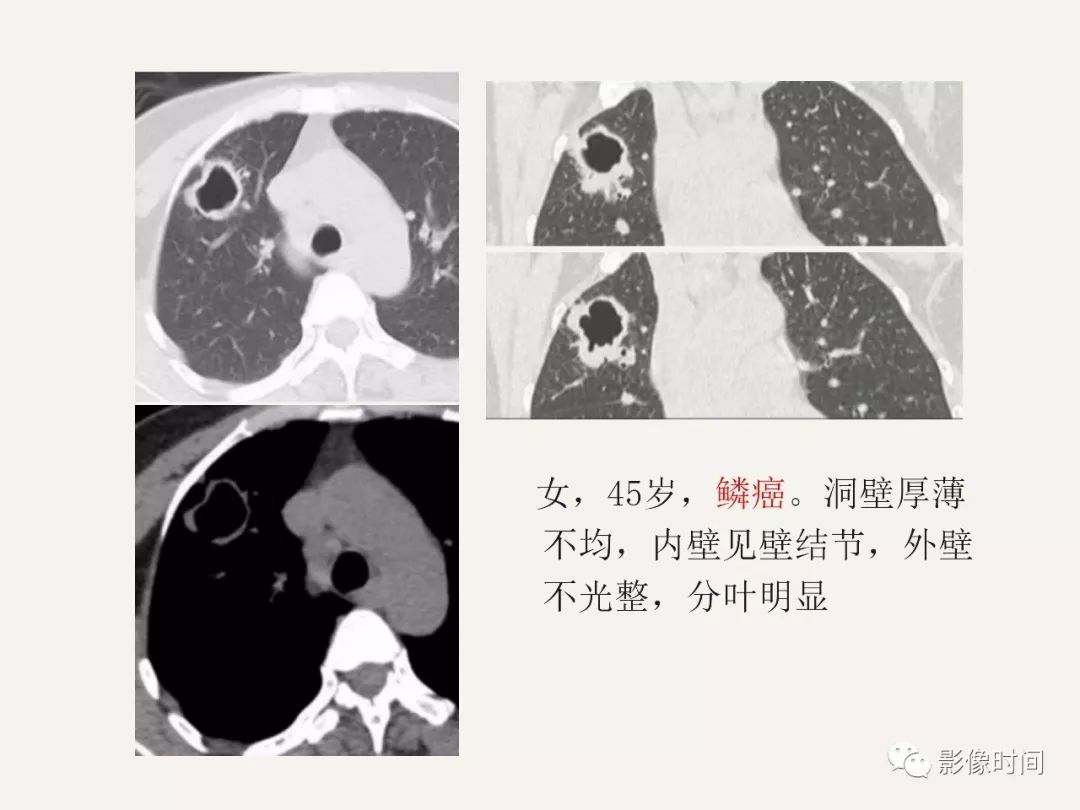 空洞型肺癌的 ct 診斷要點分析