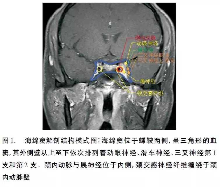 海绵窦ct解剖图片图片