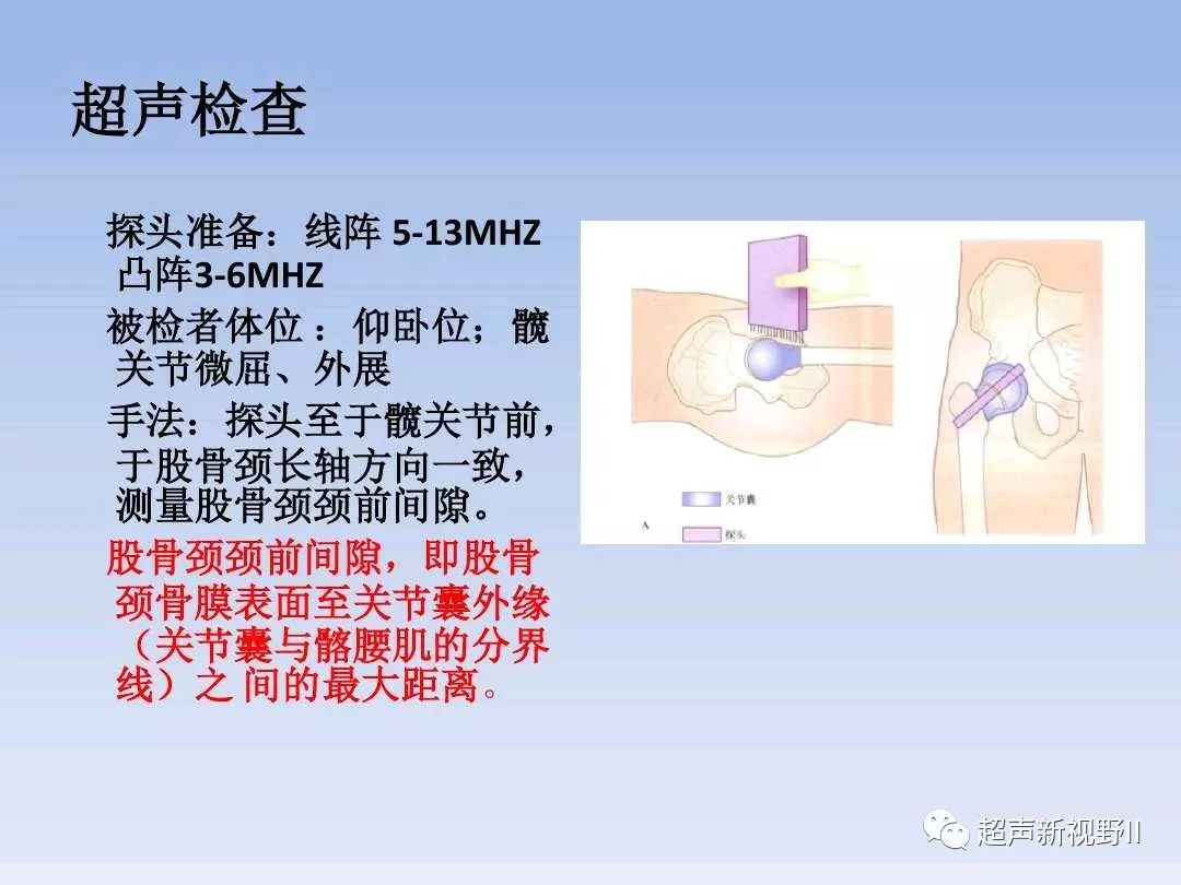 超聲微課堂小兒髖關節疾病的超聲診斷