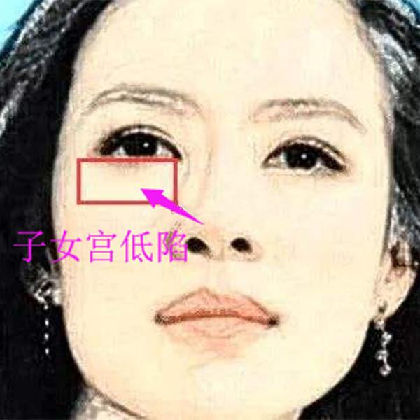 子女宫低陷