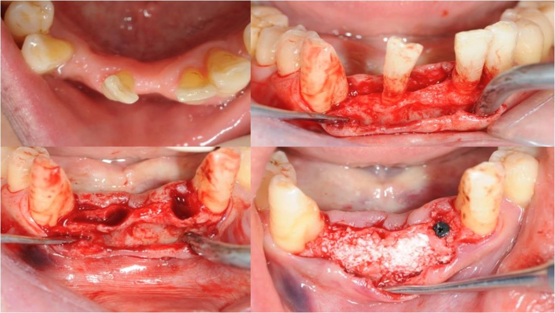 侵袭性牙周炎症状图片图片