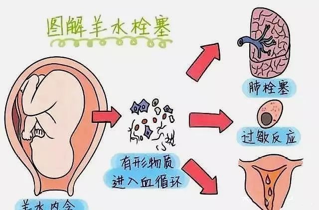 羊水栓塞可怕的背後真相是什麼